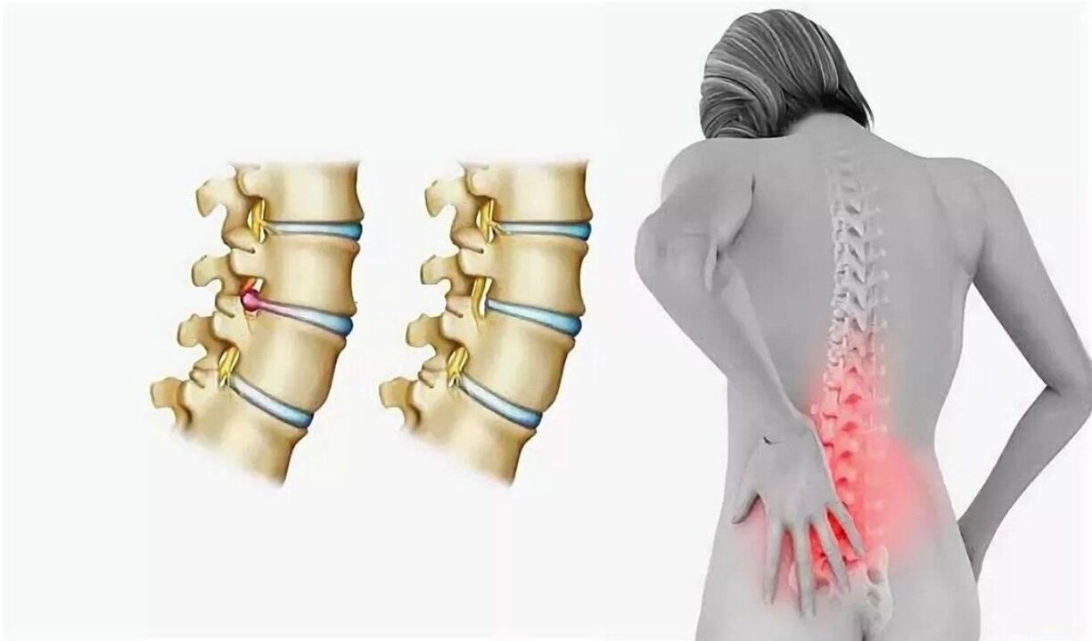 Danger of spinal osteochondrosis