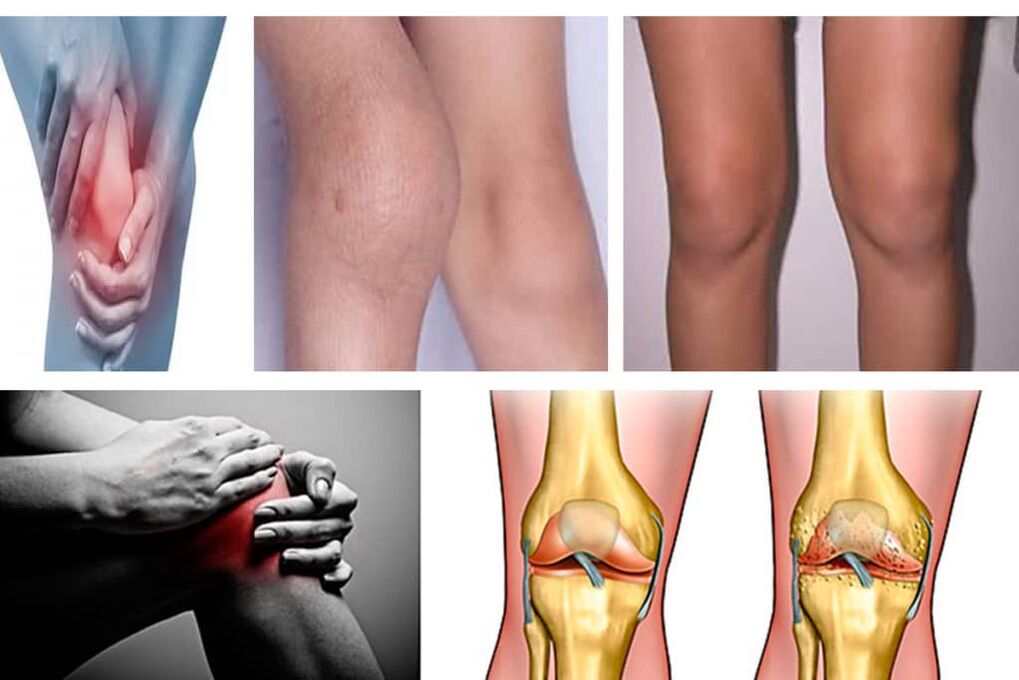 Symptoms of the osteoarthritis of the knee